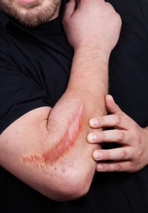 Scars, both internal and external, present a significant biomedical burden.