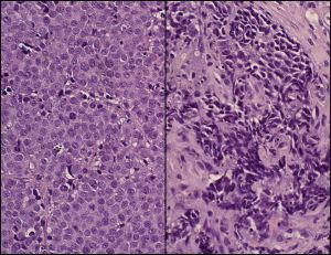 Normal prostate cells (left) and neuroendocrine prostate cancer cells (right). (UCLA news release)