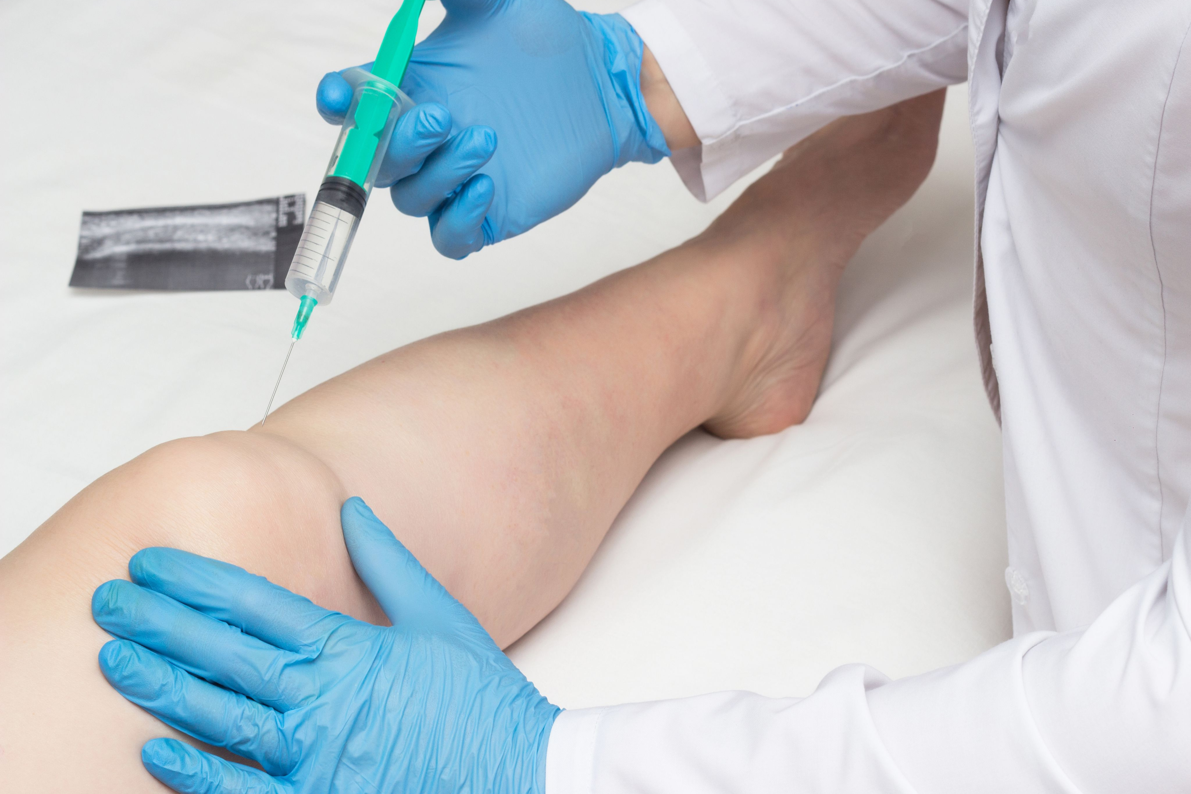 Minimally Invasive Treatment for Varicose Veins Now Available to Patients  at UCSF Radiology