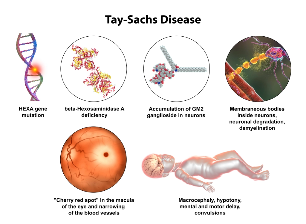 tay sachs disease research paper