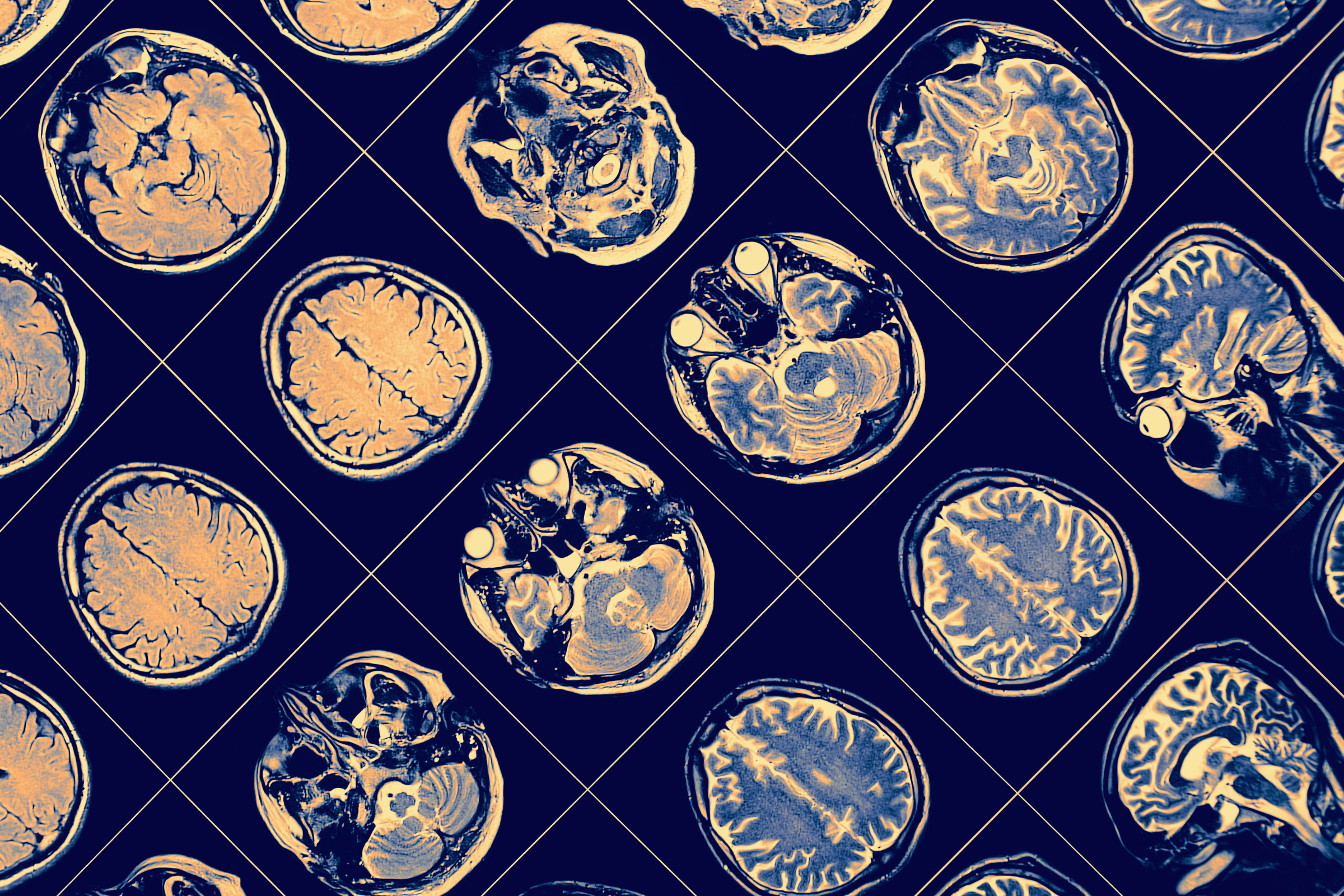 CIRM approves new plan to invest 0 million into basic research in neuropsychiatric diseases